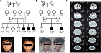 Autosomal recessive variants c.953A>C and c.97-1G>C in NSUN2 causing intellectual disability: a molecular dynamics simulation study of loss-of-function mechanisms